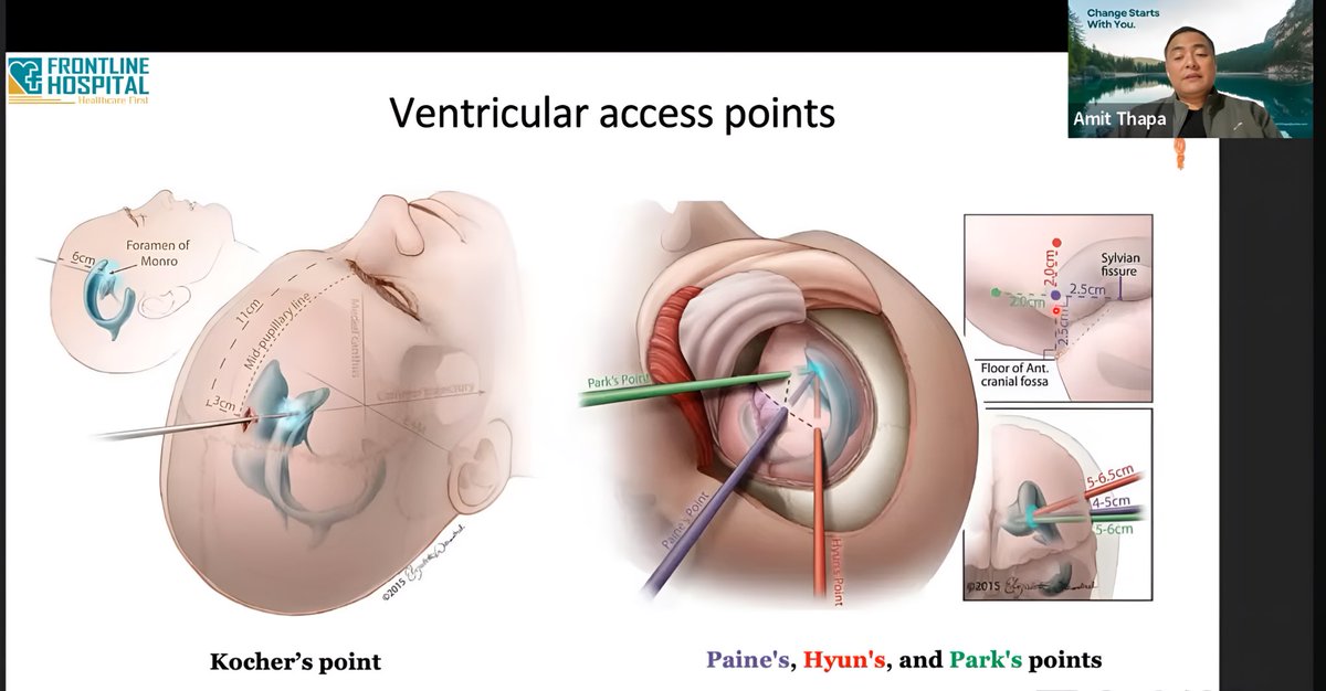 Gross Anatomy and Surface of Brain Craniometric Points and Surface Anatomy⚡️

⬇️

youtube.com/live/e-rwPdQZM…