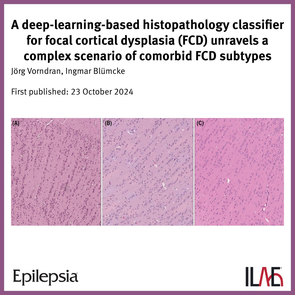 Key point: "A complex scenario of comorbid FCD subtypes became evident, for example, abundance of vertically oriented microcolumns adjacent to FCD ILAE type II lesions."

<a href="/EpilepsiaJourn/">Epilepsia</a>: doi.org/10.1111/epi.18…