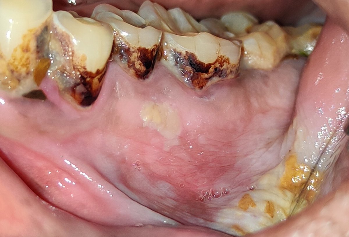 ombaghele's tweet photo. Pre-cancer and Cancer of oral cavity 
India is con..For more info visit...https://t.co/Bx0fe8lbzP https://t.co/7zgq9BadLR