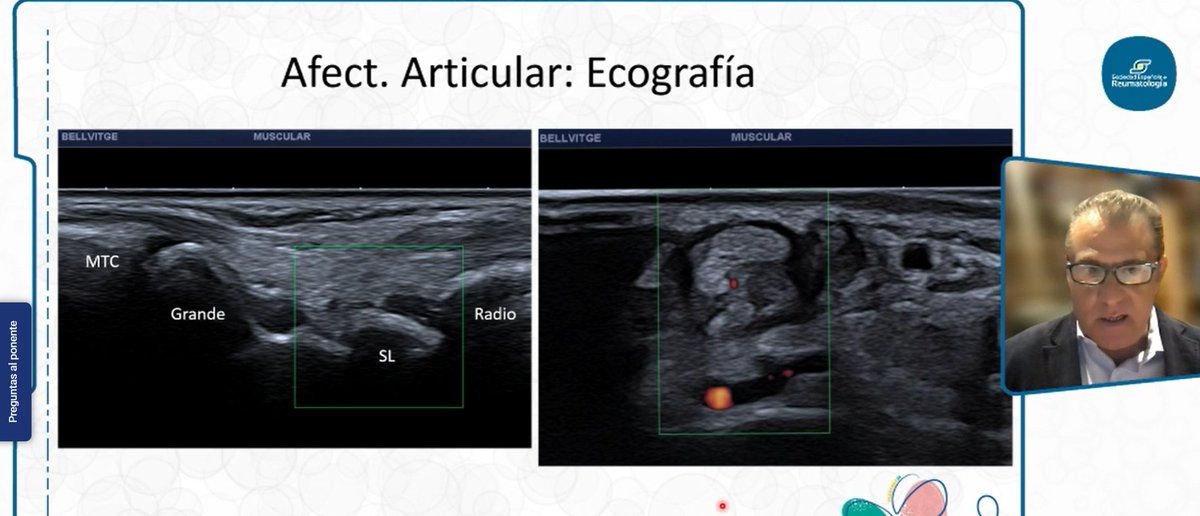 💯 ¡Comienza el segundo día del curso #LESYSAF24! 

El Dr. <a href="/JAntonioNarvaez/">J. Antonio Narváez, MD, PhD</a>, del Servicio de Radiología del <a href="/hbellvitge/">Hospital Universitari Bellvitge | HUB</a>, interviene de forma virtual para hablar sobre las técnicas de imagen en el lupus.

📌 "Tanto la ecografía como la RM son precisas y sensibles a la inflamación