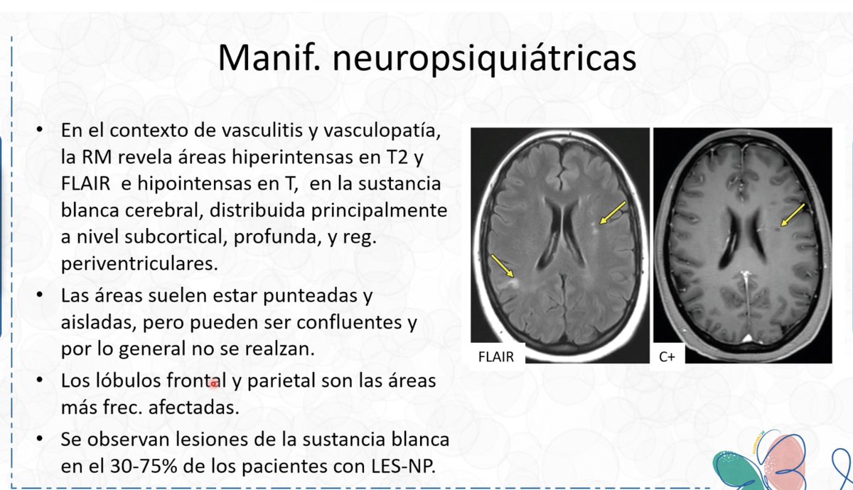 RMN en osteonecrosis. ojo q es frecuente
Pleuropulmonar: Rx, tac, angio-tac
Asociación a NINE
CardioRMN en alza
NeuroPsiquiátrico--ojo que pueden ser inespecíficos los hallazgos