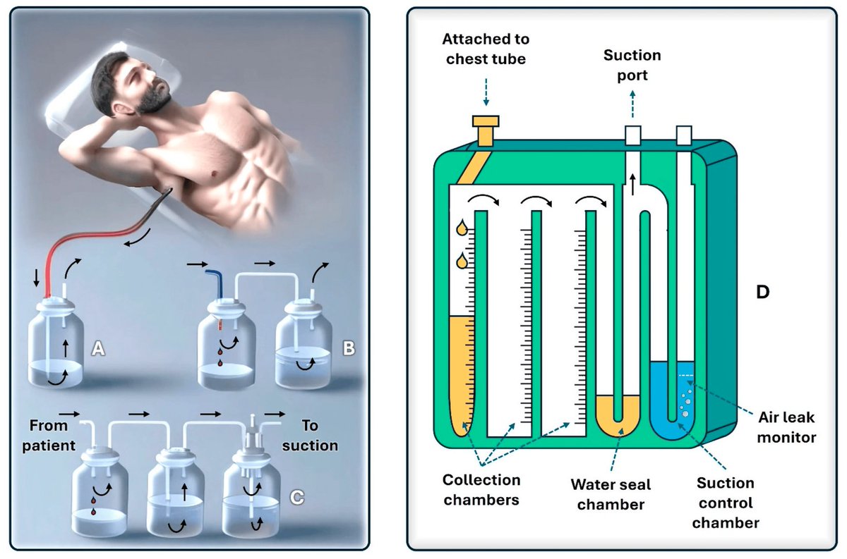 Today's Paper of the Day is on chest tubes and pleural drainage
criticalcarereviews.com/latest-evidenc…

Join us to read 1 paper per day and stay up-to-date as we cover the spectrum of critical care across 2024