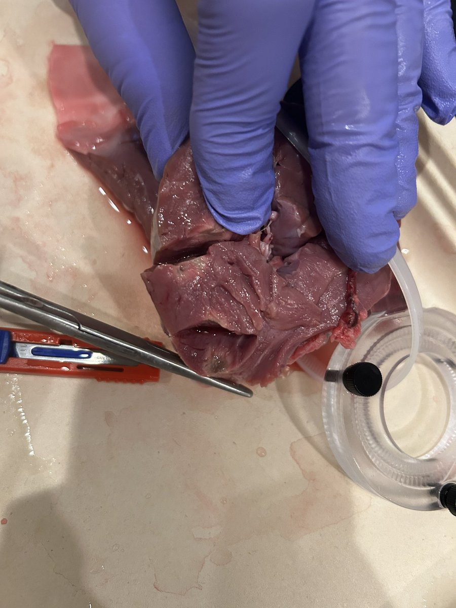 G_Goldar_MD (@g_goldar) on Twitter photo A little late to post but what a fun EP conference! Met some powerhouse women, laughed way too hard in matching trench coats (and no that was not planned!), dissected a heart, and even performed my first ablation. Just another day in cardiology… kind of! 🫀🩺 <a href="/FellowsSummit/">EP Fellows Summit & Arrhythmia Scholars Program</a> A little late to post but what a fun EP conference! Met some powerhouse women, laughed way too hard in matching trench coats (and no that was not planned!), dissected a heart, and even performed my first ablation. Just another day in cardiology… kind of! 🫀🩺 <a href="/FellowsSummit/">EP Fellows Summit & Arrhythmia Scholars Program</a>
