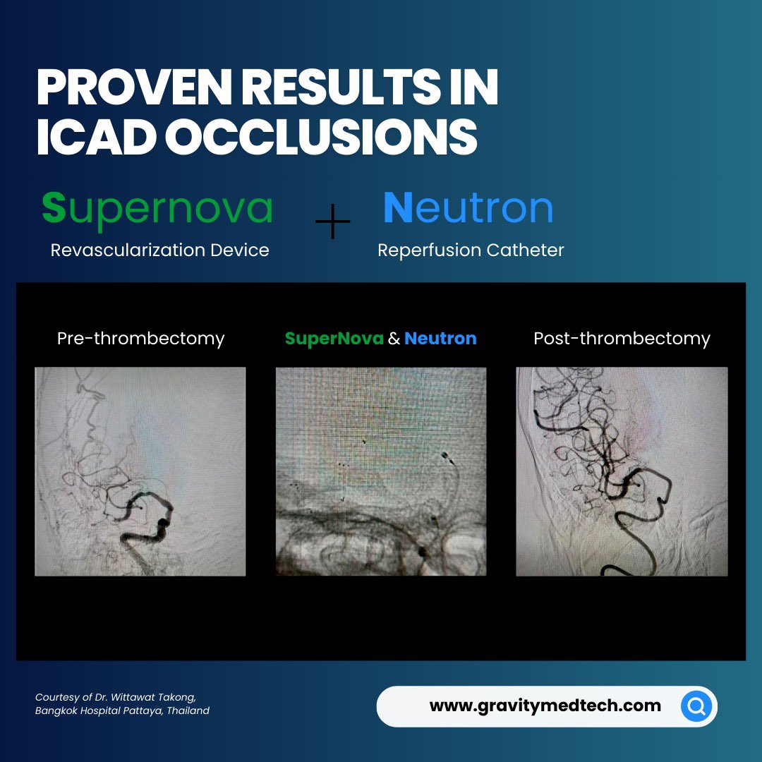 Challenging distal M1 occlusion w ICAD &amp; tortuous vasculature. Achieved first-pass recanalization w Supernova 4x43mm stent retriever (optimized for ICAD) &amp; Neutron 070 aspiration catheter. Courtesy of Dr. Wittawat Takong, Bangkok Hospital Pattaya, Thailand.