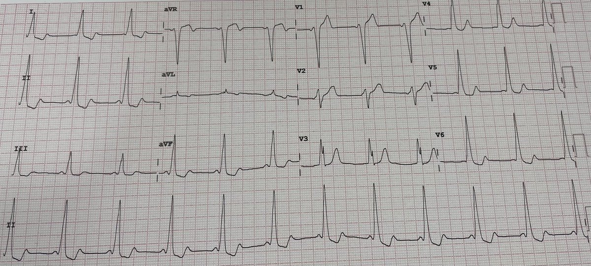 Otra de “bloqueos”: que te parece este ECG?