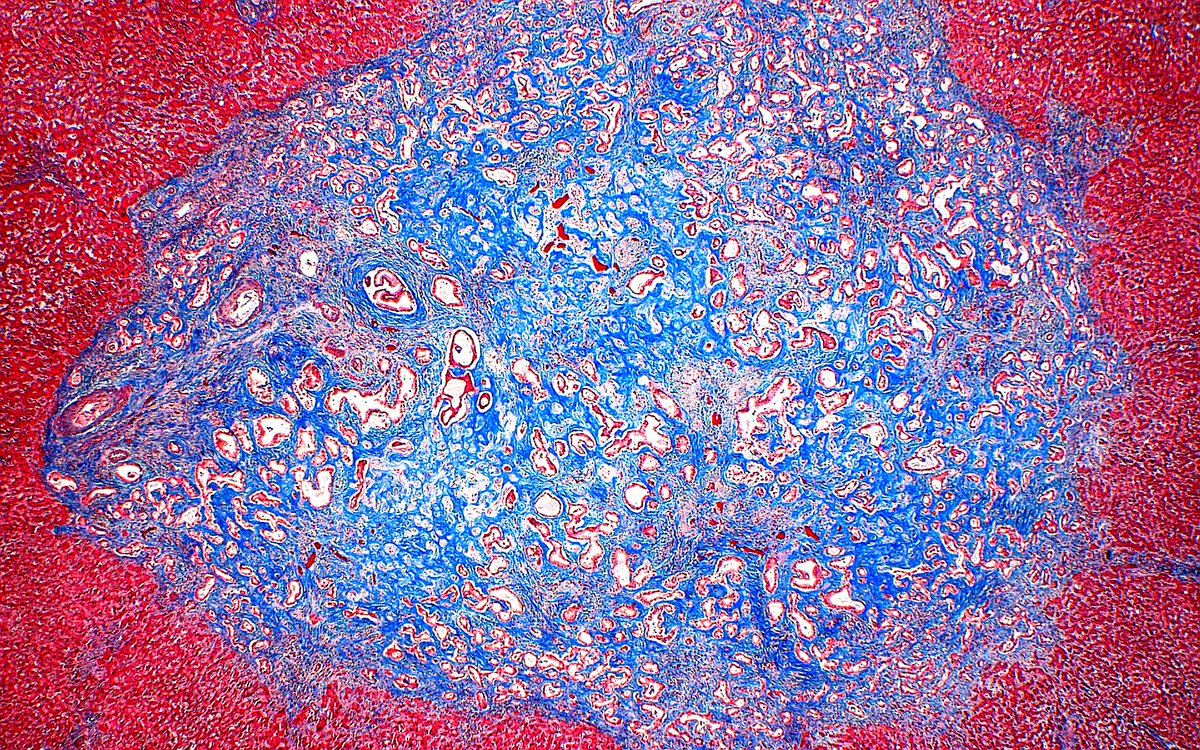 🔬 Bile Duct Adenoma (Trichrome Stain) ~ #Liver #Hepatology #Pathology #GIpath