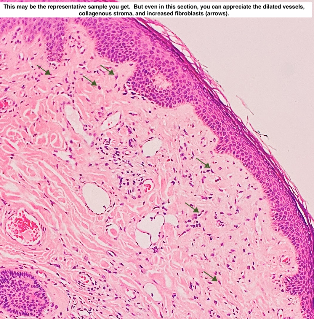 Path4People's tweet photo. 🔵 Fibrous papule AKA Angiofibroma
🔵 May clinically mimic basal cell carcinoma
🔬 👀 1) Dilated vessels 2) Collagenous Stroma 3) Increase in fibroblasts
#pathx #pathagonia #path4people #dermpath #fammed #medicine #dermatology https://t.co/u1DQyLxjlL
