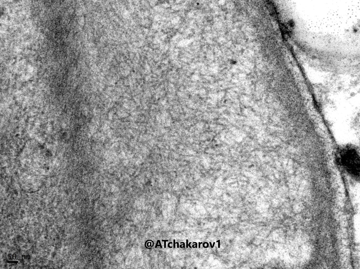 A Tchakarov (@atchakarov1) on Twitter photo Yes, randomly oriented non-branching fibrils 8-12 nm in diameter in this case of amyloid! <a href="/SibelAk_MD/">Sibel AK, MD</a> <a href="/Tahzebhafi/">Tahzeeb Hafi poetry</a> <a href="/mghbrr/">Guadalupe Hernandez</a> <a href="/AygulCeltik/">Aygul Celtik</a> Yes, randomly oriented non-branching fibrils 8-12 nm in diameter in this case of amyloid! <a href="/SibelAk_MD/">Sibel AK, MD</a> <a href="/Tahzebhafi/">Tahzeeb Hafi poetry</a> <a href="/mghbrr/">Guadalupe Hernandez</a> <a href="/AygulCeltik/">Aygul Celtik</a>