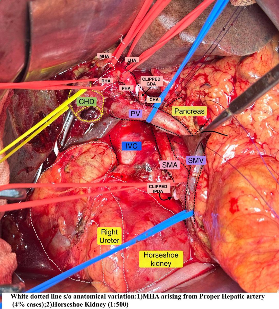 drmehul21787's tweet image. Middle Hepatic Artery : Lifeline of segment IV
( Whipple for PDAC ) 
#WhippleProcedure #PancreaticSurgery#HPBSurgery#PancreaticCancer
#LifeSavingSurgery #CancerSurvivorship
#SurgicalOncology #ComplexSurgery