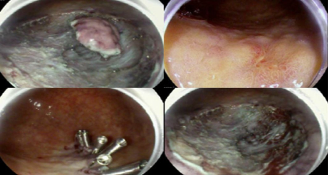 Mohamed Othman (@endoscopyothman) on Twitter photo Sharing few learning points from <a href="/KeihanianTara/">TaraKeihanian MD. MPH.</a> and I recent publication on western prospective for gastric cancer and gastric ESD:
*There has been a decreasing trend in incidence of gastric adenocarcinoma in the last 50 years in the western population due to higher rate of Sharing few learning points from <a href="/KeihanianTara/">TaraKeihanian MD. MPH.</a> and I recent publication on western prospective for gastric cancer and gastric ESD:
*There has been a decreasing trend in incidence of gastric adenocarcinoma in the last 50 years in the western population due to higher rate of