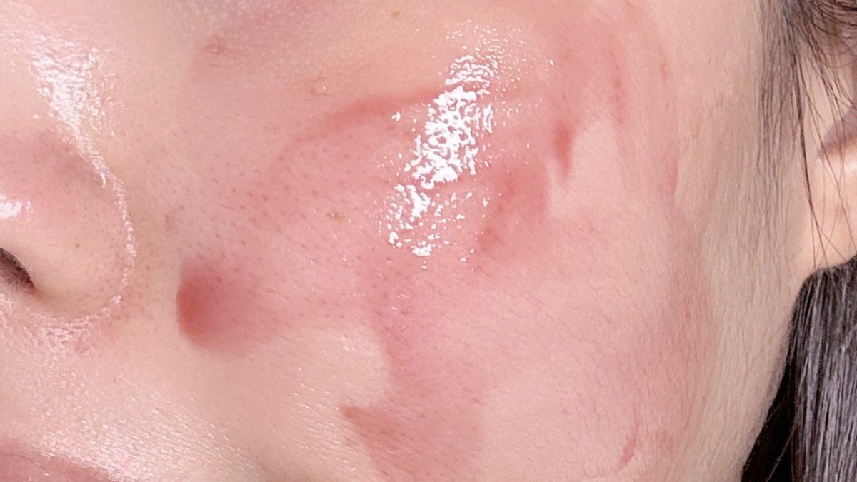 SKINTIFIC AHA BHA PHA LHA Peeling ผลัดผิว ผิวเรียบเนียนหนทางสู่ผิวกระจก🥹✨ ปล.วิใช้แค่กลางคืน อาทิตย์2-3 ครั้ง 3-4หยดลงบนหน้าที่แห้ง เริ่มใช้อาจจะไว้แค่1นาทีก่อน ใช้ไปซักพักค่อยเพิ่มเวลา แต่มากสุด5 นาทีพอ แล้วล้างออก วิมาส์กหน้า+โบกมอยส์ต่อ ผิวใสเรียบเนียน ช่วยลดสิวหัวดำที่จมูกดี รูขุมขนไม่กว้าง