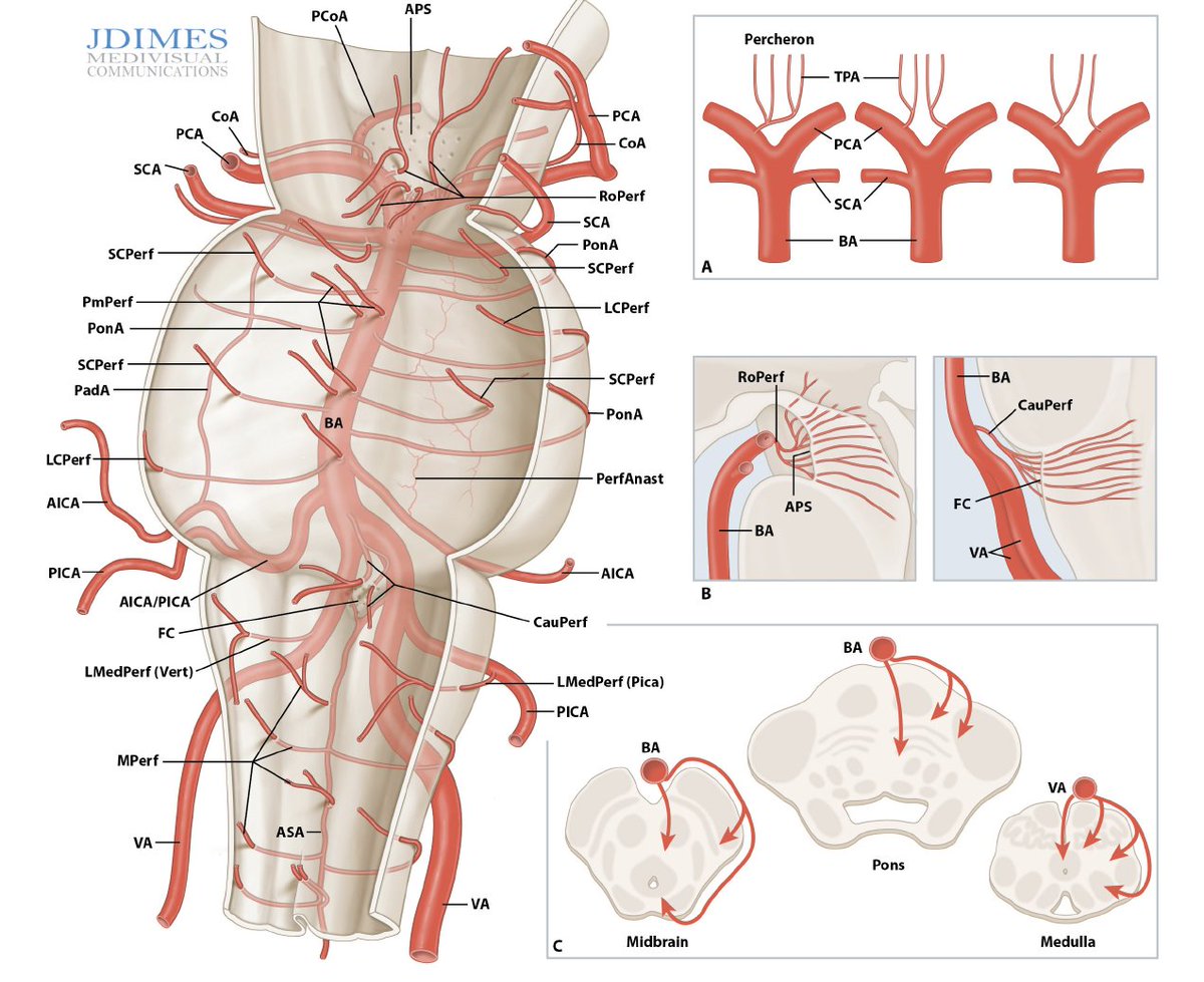 JNIS (@jnis_bmj) on Twitter photo 🤓 Do you know your vertebrobasilar perforators? Check out this review with fantastic images from <a href="/eytanraz/">Eytan Raz</a> <a href="/neuroangio1/">Neuroangio</a> <a href="/ENossek/">Erez Nossek</a> <a href="/MatthewPottsMD/">Matthew Potts</a> <a href="/SharashidzeVera/">Vera Sharashidze</a> <a href="/ChungCharlotte/">Charlotte Chung, MD PhD</a> <a href="/rdeleacymd/">Reade De Leacy MD</a> Link: bit.ly/3YFn4Yn 🤓 Do you know your vertebrobasilar perforators? Check out this review with fantastic images from <a href="/eytanraz/">Eytan Raz</a> <a href="/neuroangio1/">Neuroangio</a> <a href="/ENossek/">Erez Nossek</a> <a href="/MatthewPottsMD/">Matthew Potts</a> <a href="/SharashidzeVera/">Vera Sharashidze</a> <a href="/ChungCharlotte/">Charlotte Chung, MD PhD</a> <a href="/rdeleacymd/">Reade De Leacy MD</a> Link: bit.ly/3YFn4Yn