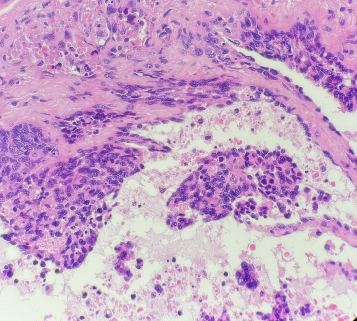 45 yr old male with infiltrating thyroid mass.
