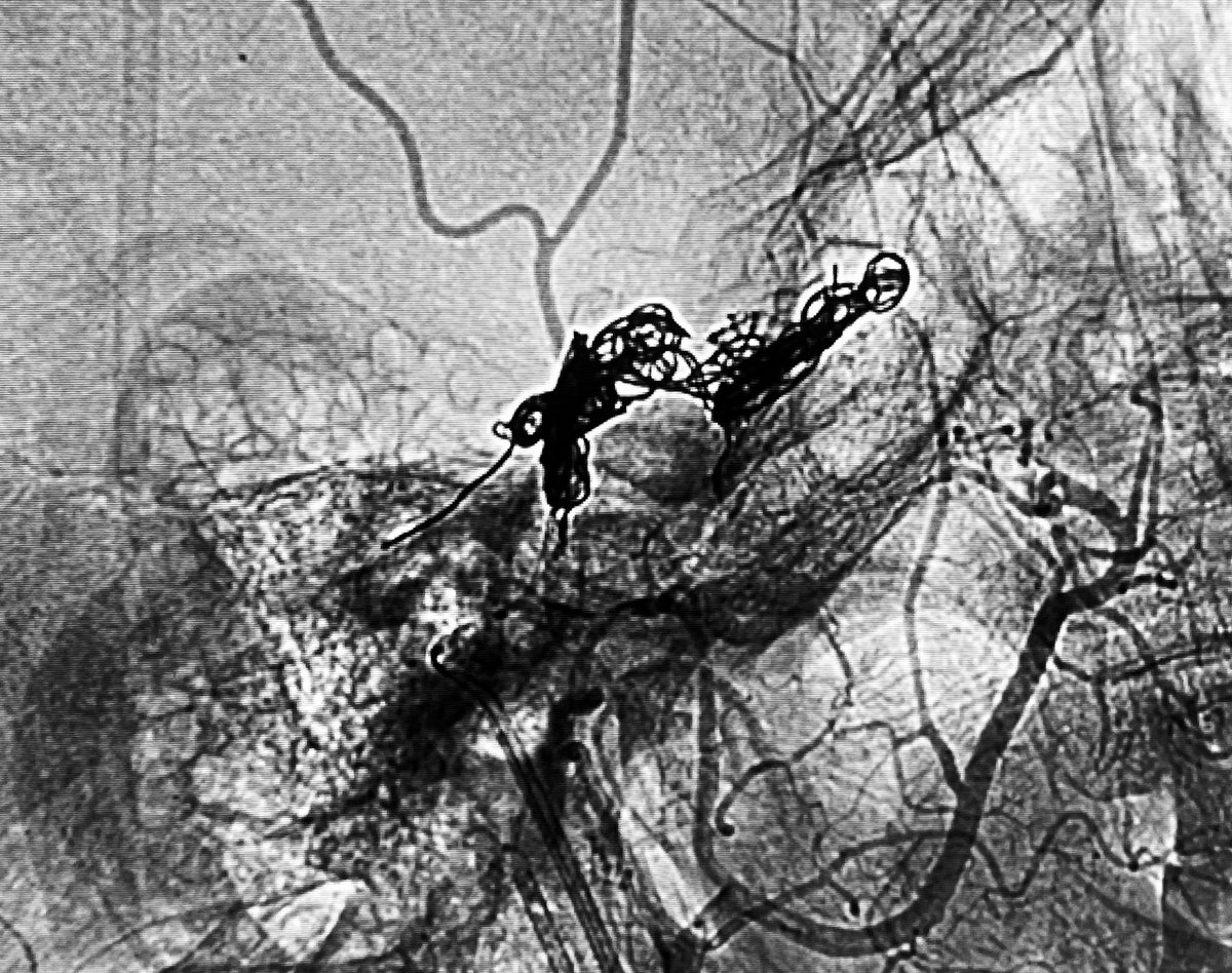 Type D2 CCF, closed by ipsilateral transvenous double-catheter technique for coiling and onyx injection. Minimal approach for better results :))