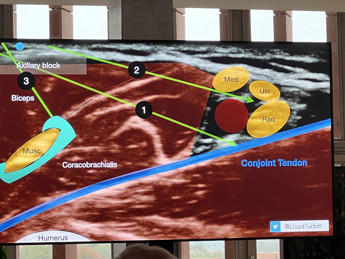 Dr Amit Pawa💉🎙️ (@amit_pawa) on Twitter photo It’s as Easy as 1, 2, 3!
Making sure you generate the Turbitt-Click as you pass towards the Radial
<a href="/LloydTurbitt/">Lloyd Turbitt</a> It’s as Easy as 1, 2, 3!
Making sure you generate the Turbitt-Click as you pass towards the Radial
<a href="/LloydTurbitt/">Lloyd Turbitt</a>
