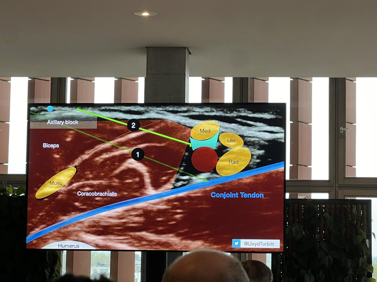 Steve Coppens (@steve_coppens) on Twitter photo <a href="/LloydTurbitt/">Lloyd Turbitt</a> Astonishingly beautiful slides on axillary plexus block 😍🥰😍🥰😍 <a href="/RegionalAnaesUK/">RA-UK</a> <a href="/BelgianBara/">Belgian Association of Regional Anesthesia BARA</a> <a href="/ESRA_Society/">ESRA | European Society of Regional Anaesthesia</a> <a href="/ASRA_Society/">ASRA Pain Medicine</a> <a href="/LloydTurbitt/">Lloyd Turbitt</a> Astonishingly beautiful slides on axillary plexus block 😍🥰😍🥰😍 <a href="/RegionalAnaesUK/">RA-UK</a> <a href="/BelgianBara/">Belgian Association of Regional Anesthesia BARA</a> <a href="/ESRA_Society/">ESRA | European Society of Regional Anaesthesia</a> <a href="/ASRA_Society/">ASRA Pain Medicine</a>