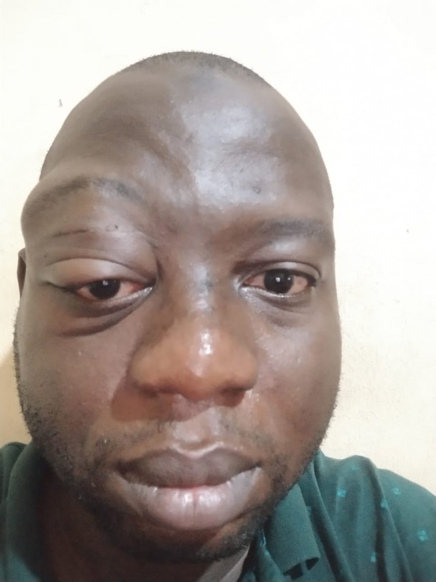 Baridueh Badon (@badonb) on Twitter photo Dear good people!
We have raised N170M 🙌. We only have N90M left 🙏.
Dr. Idris is currently processing visa applications. He will leave ASAP.
We will focus now on our oga's to donate something huge. Today, let's appeal to <a href="/DONJAZZY/">SUPREMOS 🤍🐘</a> to shake body.
1. Let us tag him 1k Dear good people!
We have raised N170M 🙌. We only have N90M left 🙏.
Dr. Idris is currently processing visa applications. He will leave ASAP.
We will focus now on our oga's to donate something huge. Today, let's appeal to <a href="/DONJAZZY/">SUPREMOS 🤍🐘</a> to shake body.
1. Let us tag him 1k