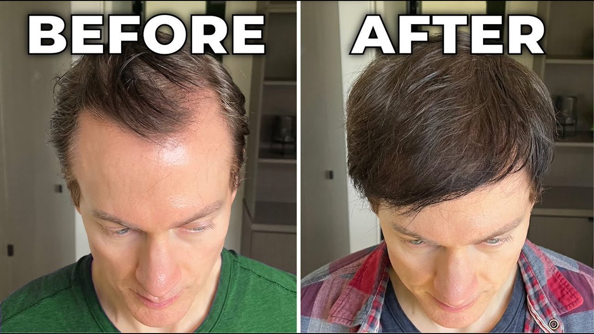 Genetically, I should be bald.

I started to lose my hair and go gray in my late 20s.

Now, at 37, I’ve got a full head of hair and ~70% of my gray is gone.

Here how I did it.. 🧵