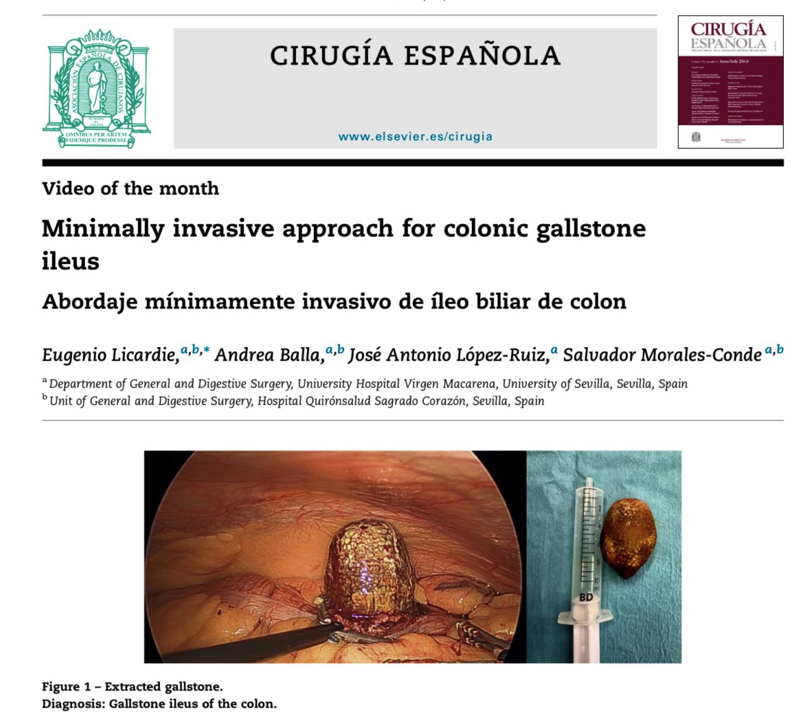 Eugenio Licardie (@eugeniolicardie) on Twitter photo Minimally invasive approach for colonic gallstone ileus.
Video of the month <a href="/cirugiaespanola/">CirugĆa EspaƱola</a>.
<a href="/smoralesconde/">Salvador Morales Conde</a> @Wurdalach1 <a href="/AndreaBalla7/">Andrea Balla</a> <a href="/scmi_itec/">aec_cmi</a> <a href="/aecirujanos/">aecirujanos</a>
Link:
authors.elsevier.com/c/1d8fx,EB2Do3s Minimally invasive approach for colonic gallstone ileus.
Video of the month <a href="/cirugiaespanola/">CirugĆa EspaƱola</a>.
<a href="/smoralesconde/">Salvador Morales Conde</a> @Wurdalach1 <a href="/AndreaBalla7/">Andrea Balla</a> <a href="/scmi_itec/">aec_cmi</a> <a href="/aecirujanos/">aecirujanos</a>
Link:
authors.elsevier.com/c/1d8fx,EB2Do3s