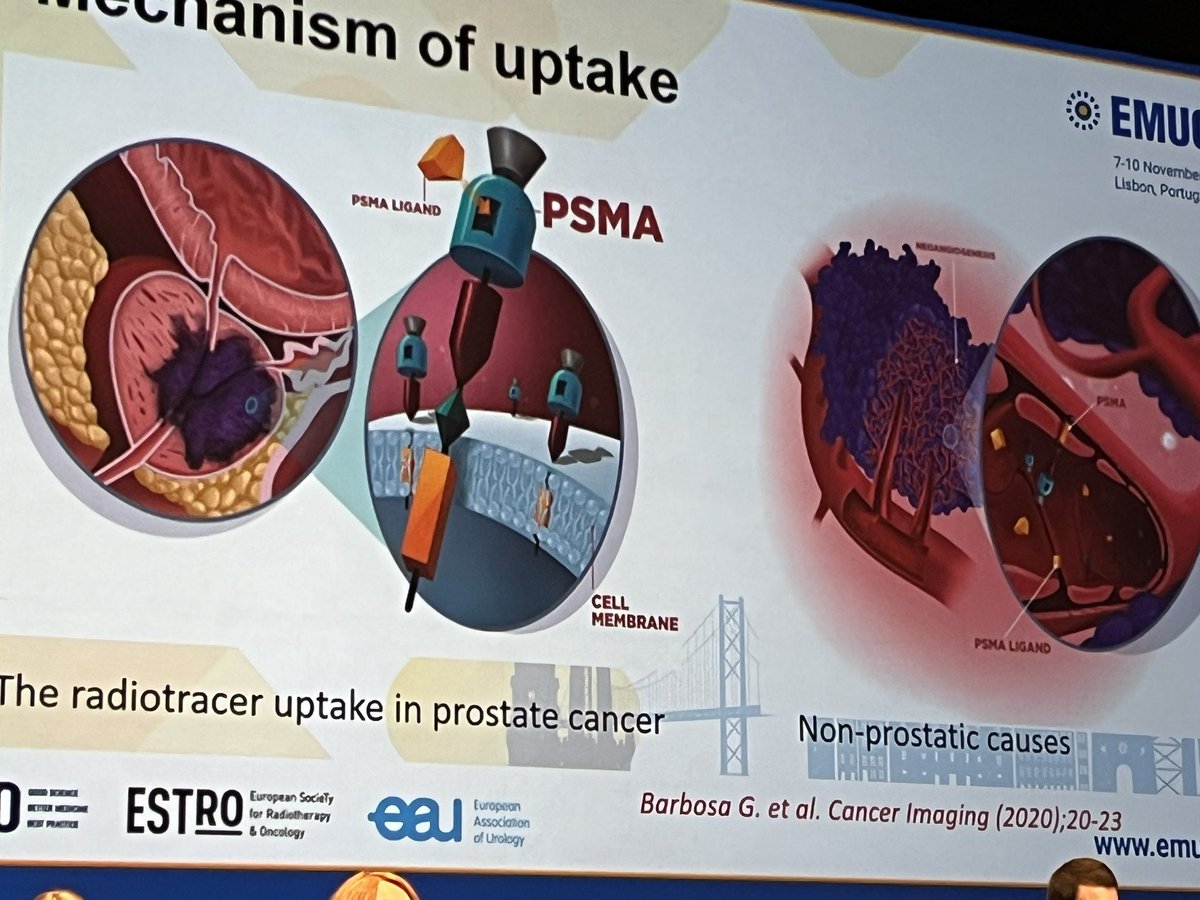 Lorenzo Bianchi (@lorenzo26232839) on Twitter photo PSMA expression in prostate cancers cells may still be different from non-cancer tissue: interesting discussion and pitfalls and optima use of PSMA PET in prostate cancer at #EMUC24 <a href="/andrea_farolfi/">Andrea Farolfi</a> <a href="/RiccardoMe36556/">Riccardo Mei (RM)</a> PSMA expression in prostate cancers cells may still be different from non-cancer tissue: interesting discussion and pitfalls and optima use of PSMA PET in prostate cancer at #EMUC24 <a href="/andrea_farolfi/">Andrea Farolfi</a> <a href="/RiccardoMe36556/">Riccardo Mei (RM)</a>