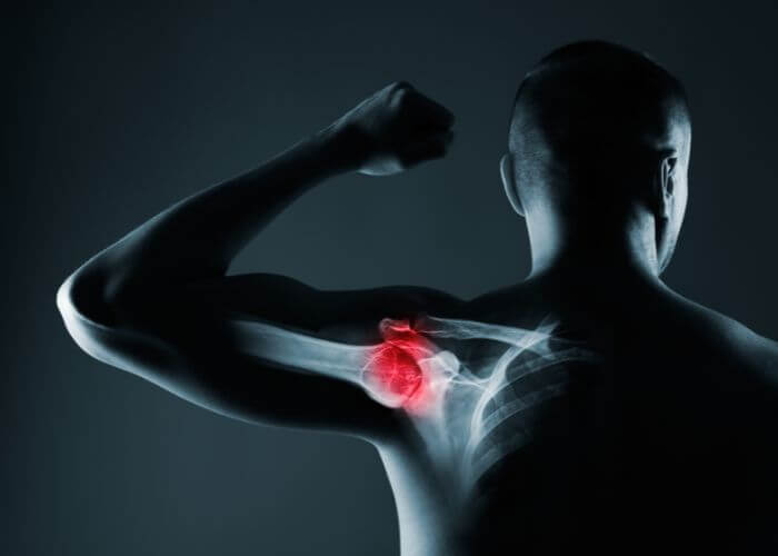 rileywilliamsMD's tweet image. Shoulder “locking” or “catching” when you move? Loose bodies could be the hidden culprit! Learn more about symptoms and treatments to keep your shoulder strong and pain-free: https://medilink. us/5r4w  #OrthopedicCare #ShoulderMobility