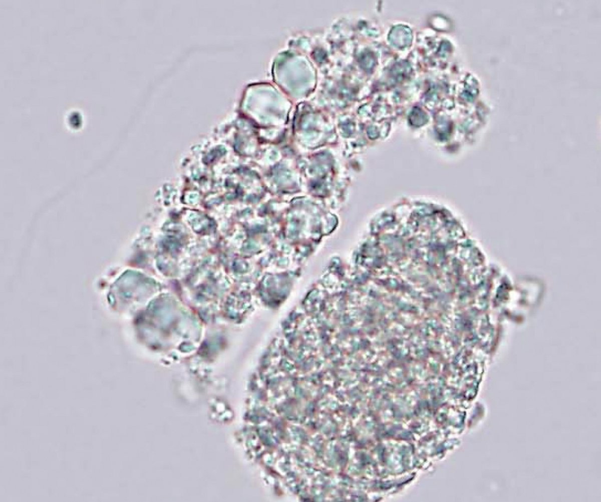 Kidney_Int's tweet image. Urinary casts containing crystals in light chain proximal tubulopathy

doi.org/10.1016/j.kint…

#NephrologyImage #renalpath #kidneypath #kidneybiopsy #renalbiopsy