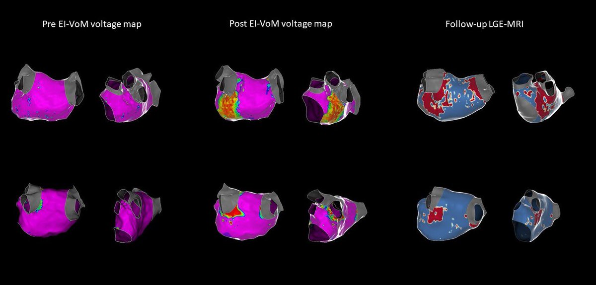 Julia Aranyó (@aranyojulia) on Twitter photo 🆕 Very happy to see our work published: “Left Atrial Structure and Function Following Ethanol Infusion into Vein of Marshall (MR-SHALL Study)”.
▶️ Permanent scar, no adverse impact on LA function. #Epeeps #AblateAF
<a href="/bisbal_EP/">Felipe Bisbal</a> <a href="/Dr_ATeis/">Albert Teis, MD, PhD</a>
<a href="/JCardioEP/">Journal of Cardiovascular Electrophysiology</a> doi.org/10.1111/jce.16… 🆕 Very happy to see our work published: “Left Atrial Structure and Function Following Ethanol Infusion into Vein of Marshall (MR-SHALL Study)”.
▶️ Permanent scar, no adverse impact on LA function. #Epeeps #AblateAF
<a href="/bisbal_EP/">Felipe Bisbal</a> <a href="/Dr_ATeis/">Albert Teis, MD, PhD</a>
<a href="/JCardioEP/">Journal of Cardiovascular Electrophysiology</a> doi.org/10.1111/jce.16…
