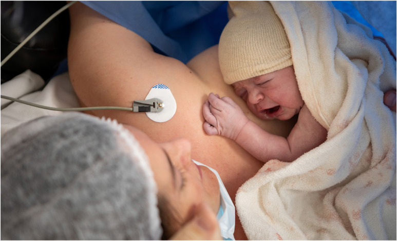In 17 studies that reported results for cesarean birth after implementation of the enhanced recovery after surgery (ERAS) protocols, on average 40% of women experienced an opioid-free inpatient recovery.

Read more at: nwhjournal.org/article/S1751-…

#NWH #AWHONN