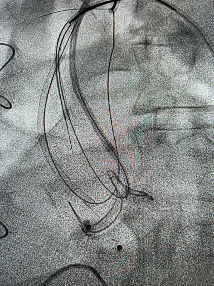 chris_malkin4's tweet image. Organised chaos in leeds structural lab; 10x5 avp3 in a NC sinus PVL- then doppio basilica of left and right leaflets followed by viv #tavr. With Tpw and sentinel. But home next day