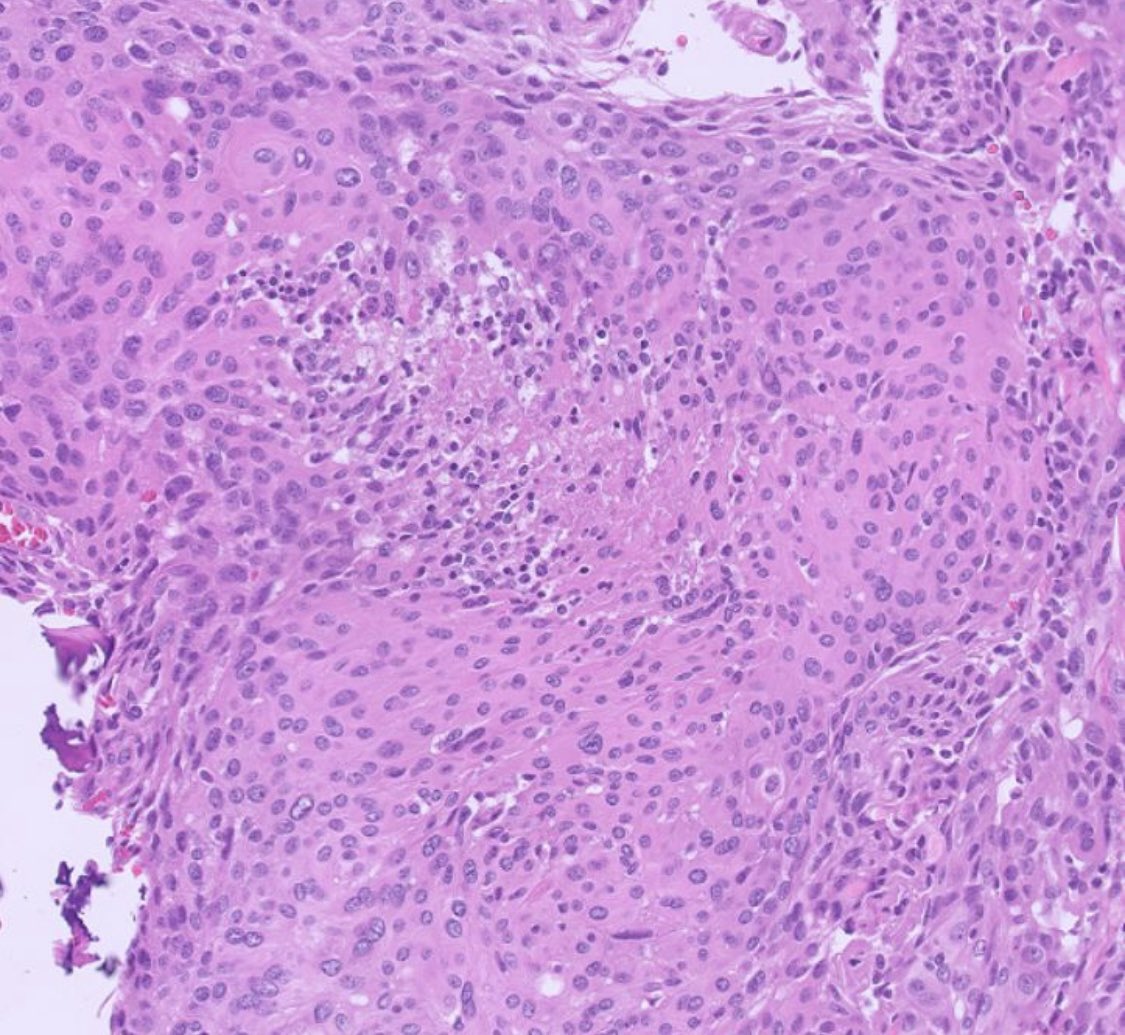 PeterKobalka's tweet image. Meningioma displaying necrosis with pseudo pallisading.  Not just a feature seen in some high-grade gliomas! #cnspath #neuropath #neuropathology #pathtwitter #pathx