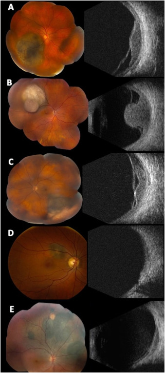 Ophthalmology (@aaojournal) on Twitter photo On multivariate analysis adjusted for tumor diameter and thickness, multilobulated melanomas were associated with a higher risk of metastasis and death. <a href="/LADalvinMD/">Lauren A. Dalvin, MD</a>
ow.ly/icI450TxyBr On multivariate analysis adjusted for tumor diameter and thickness, multilobulated melanomas were associated with a higher risk of metastasis and death. <a href="/LADalvinMD/">Lauren A. Dalvin, MD</a>
ow.ly/icI450TxyBr