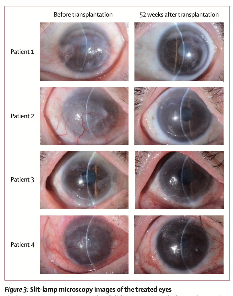 Restoring vision with "world’s first use of corneal epithelial cell sheets derived from human induced pluripotent stem cells (iPSCs) to treat LSCD." 
thelancet.com/journals/lance…
nature.com/articles/d4158…