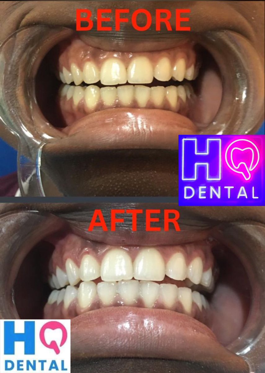 HQ dental ( high quality Dental Est) (@movicati) on Twitter photo 
