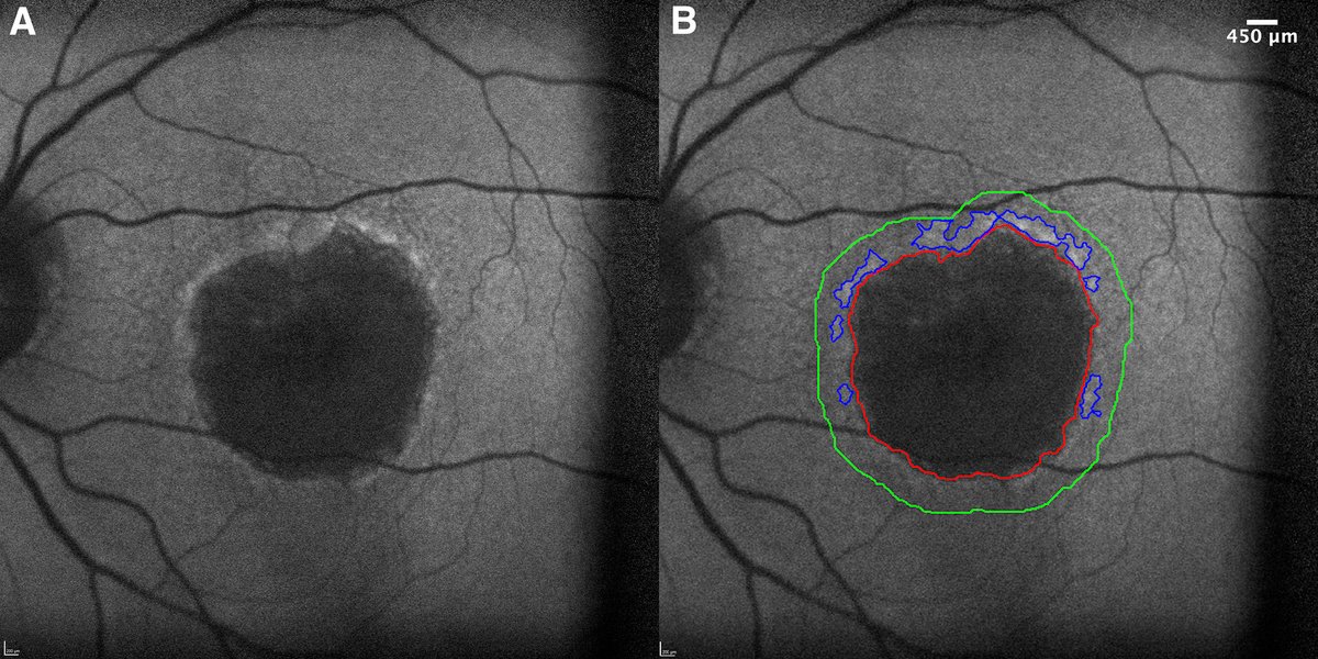Association of Hyperautofluorescence Signals with Geographic Atrophy Progression in the METforMIN Trial
ow.ly/9crO50TweZn
#ophthalmology