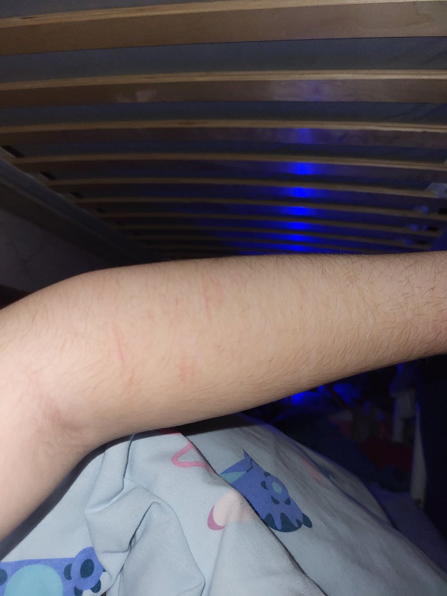 cutdarling's tweet photo. scar check :p final one forever in theory im going to recover!!!!! https://t.co/EAtgup9jTH