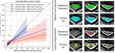 Radiology: Artificial Intelligence (@radiology_ai) on Twitter photo #SCIseg accurately segmented intramedullary lesions on a diverse dataset of T2-w MRIs doi.org/10.1148/ryai.2… <a href="/naga_karthik7/">Naga Karthik</a> <a href="/DrAndrewCSmith/">Andrew C. Smith, PT, DPT, PhD</a> <a href="/DrKenWeber/">Ken Weber, DC, PhD</a> #segmentation #MSKRad #spine #SCIseg accurately segmented intramedullary lesions on a diverse dataset of T2-w MRIs doi.org/10.1148/ryai.2… <a href="/naga_karthik7/">Naga Karthik</a> <a href="/DrAndrewCSmith/">Andrew C. Smith, PT, DPT, PhD</a> <a href="/DrKenWeber/">Ken Weber, DC, PhD</a> #segmentation #MSKRad #spine