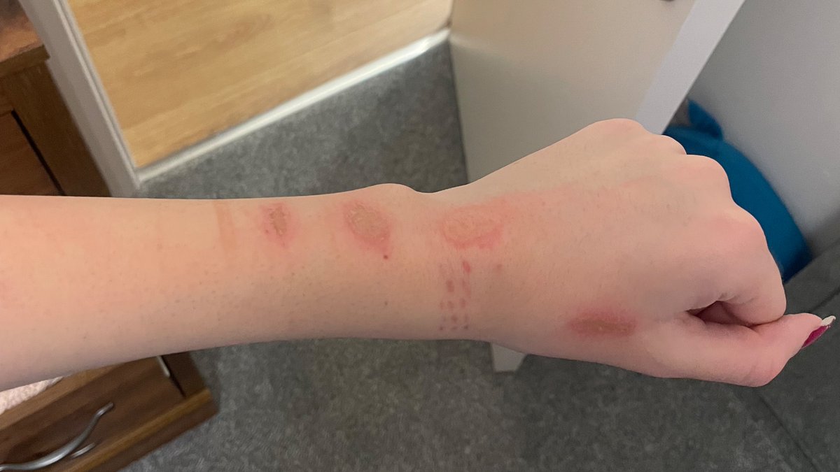 pr04n4_'s tweet photo. second admission
- weight: 55kg
- escalating self harm (burns, scraping off skin)
- admitted for attempted su1cide https://t.co/Trs3TT9HD8