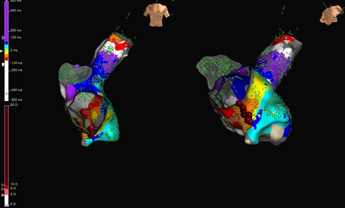 FergieLosiniec1's tweet image. CTI PVI with @AbbottCardio and the new HD Grid X, can anyone spot the congenital anomaly?  Great case  @joel_chic @Mapbastian