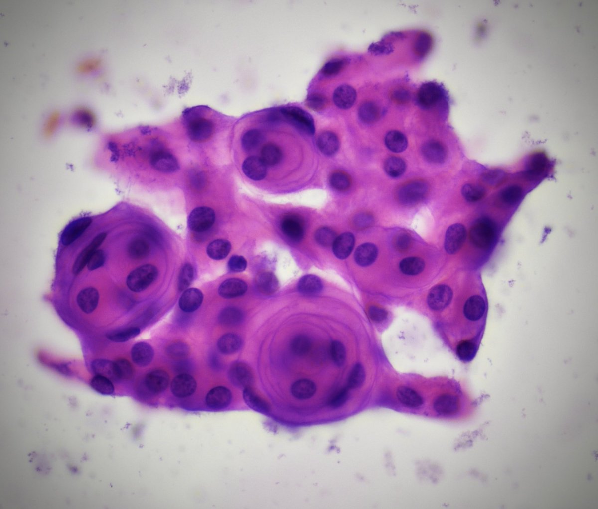 Photogenic whorls of menignioma on smears! #neurocytology #cytology #neuropathology