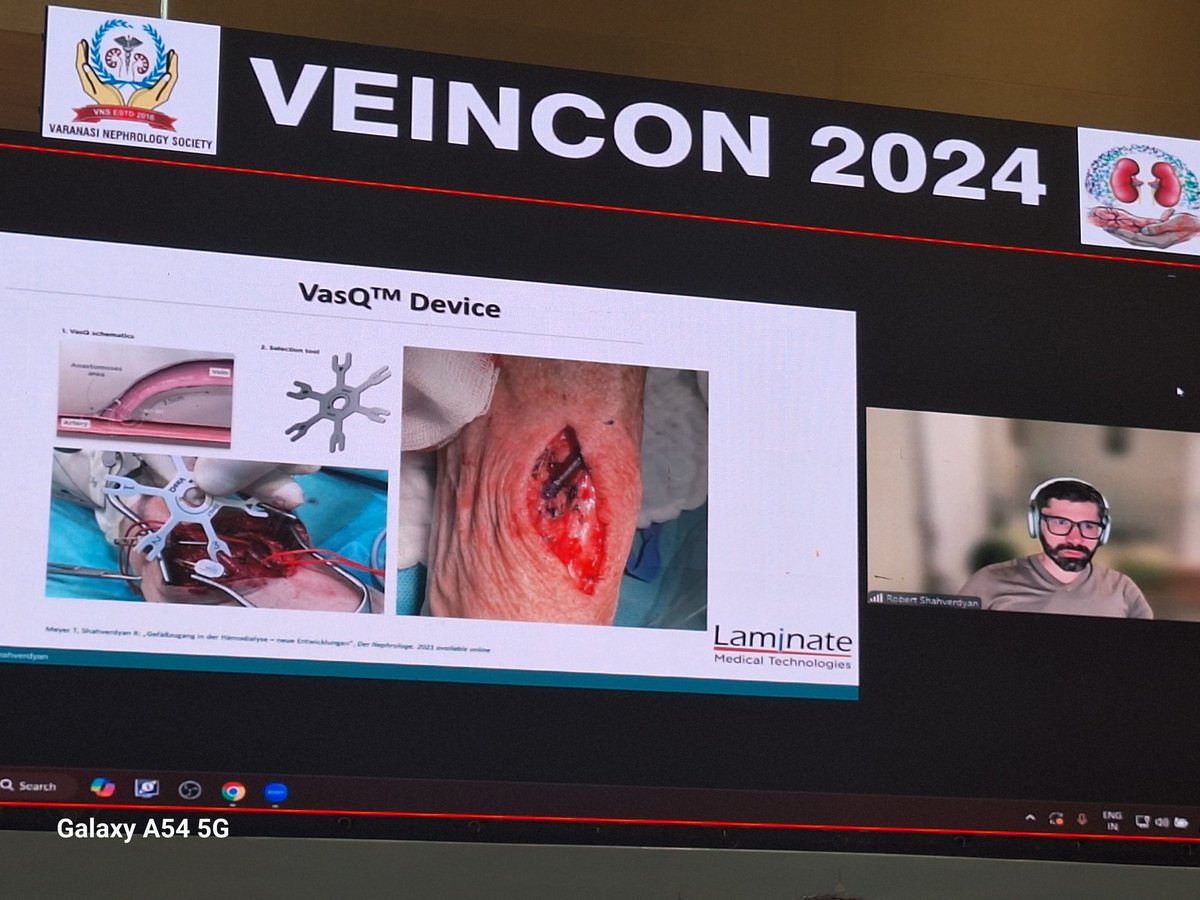 Amazing talk going on at the <a href="/theveincon/">Veincon</a>  <a href="/robshahverdyan/">Robert Shahverdyan, MD</a> speaking on his experieces with Vas-Q and endovascular AVF  youtube.com/live/GcXLsUEQ6