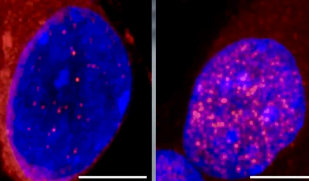 enilev's tweet photo. 🚨Pathway Identified for #Early #Intervention in #ALS Progression
Source: @UCSanDiego
By @NeuroscienceNew
#Neurology #Neuroscience
#Neurodegeneration #Proteins #SmD1 #CHMP7 #Neurons
👉https://t.co/R5x6piifHh @mvollmer1 @Khulood_Almani @Shi4Tech
@Fabriziobustama @jblefevre60 @BetaMoroney @CurieuxExplorer @efipm @AndrewinContact @ipfconline1 @Nicochan33 @HaroldSinnott @avrohomg @PawlowskiMario @drsharwood @mikeflache @GlenGilmore @fogle_shane @dinisguarda @theomitsa @Eli_Krumova @KanezaDiane @efipm @pierrecappelli @JoannMoretti @FrRonconi @RLDI_Lamy @EstelaMandela @c4trends @LavaletteAstrid @dez_blanchfield @anand_narang @Ym78200 @Analytics_699 @gvalan @margaretsiegien @kalydeoo @pierrecappelli @debashis_dutta @bamitav @c4trends @joana_ut @baski_LA @HeinzVHoenen @SwissCognitive
#seohashtag #HealthTech #DigitalHealth
Credit : UCSDiego