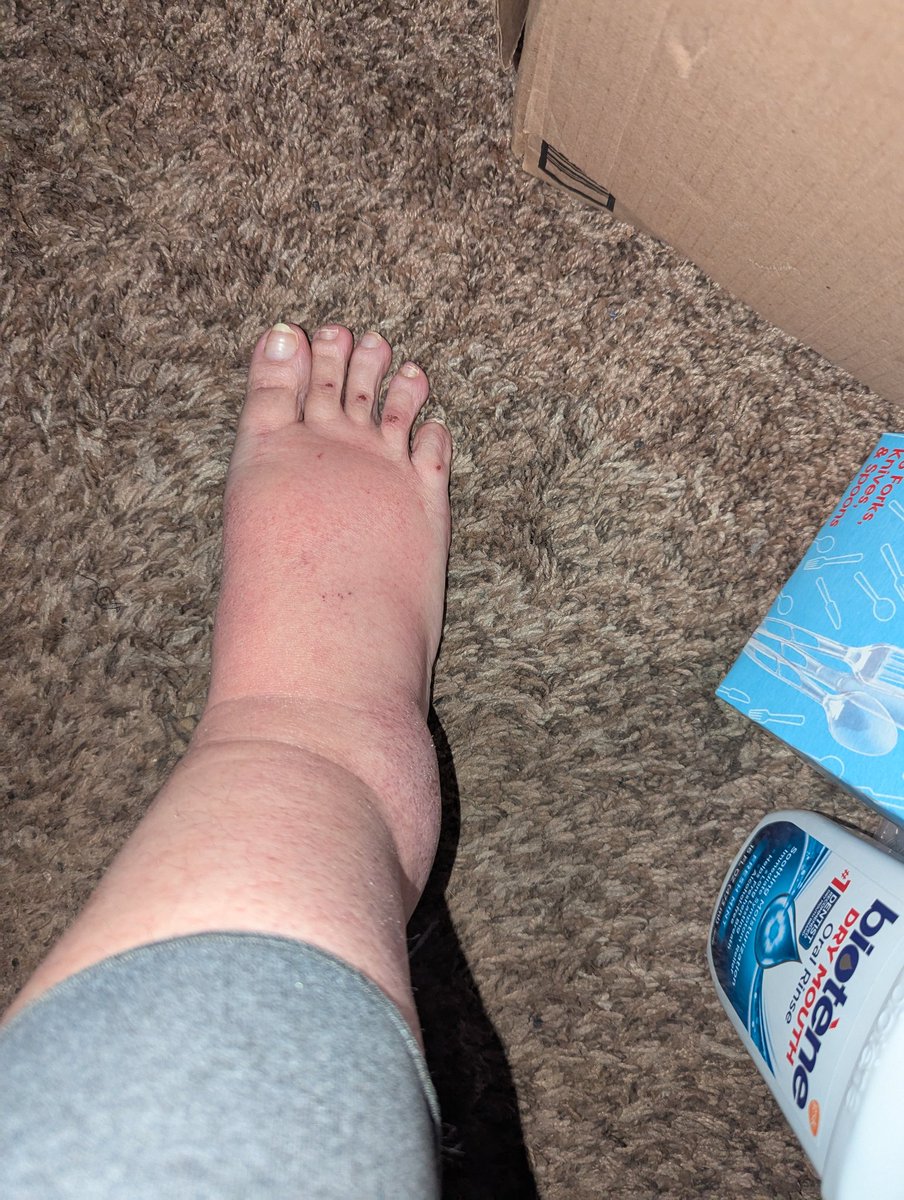 Jaylee2076's tweet photo. #ThanksCancer has anyone else had issues with hands & feet swelling like this? I seriously do not want to go back to the hospital for water retention or edema or whatever this is. #Caturday #cats #FuckoffCancer https://t.co/pbheCFwUXW