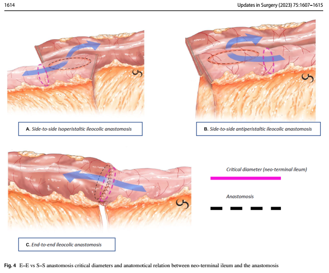 IBDGastroDocSg's tweet photo. S2S vs E2E anastomoses in Crohn's disease
- retrospective series (n=127)
- similar rates of endoscopic recurrence
- lower surgical recurrence with S2S

Possible reasons:
- less faecal stasis
- greater distance b/w stapler line and neo-TI inflammation https://t.co/VAvPRebWlE