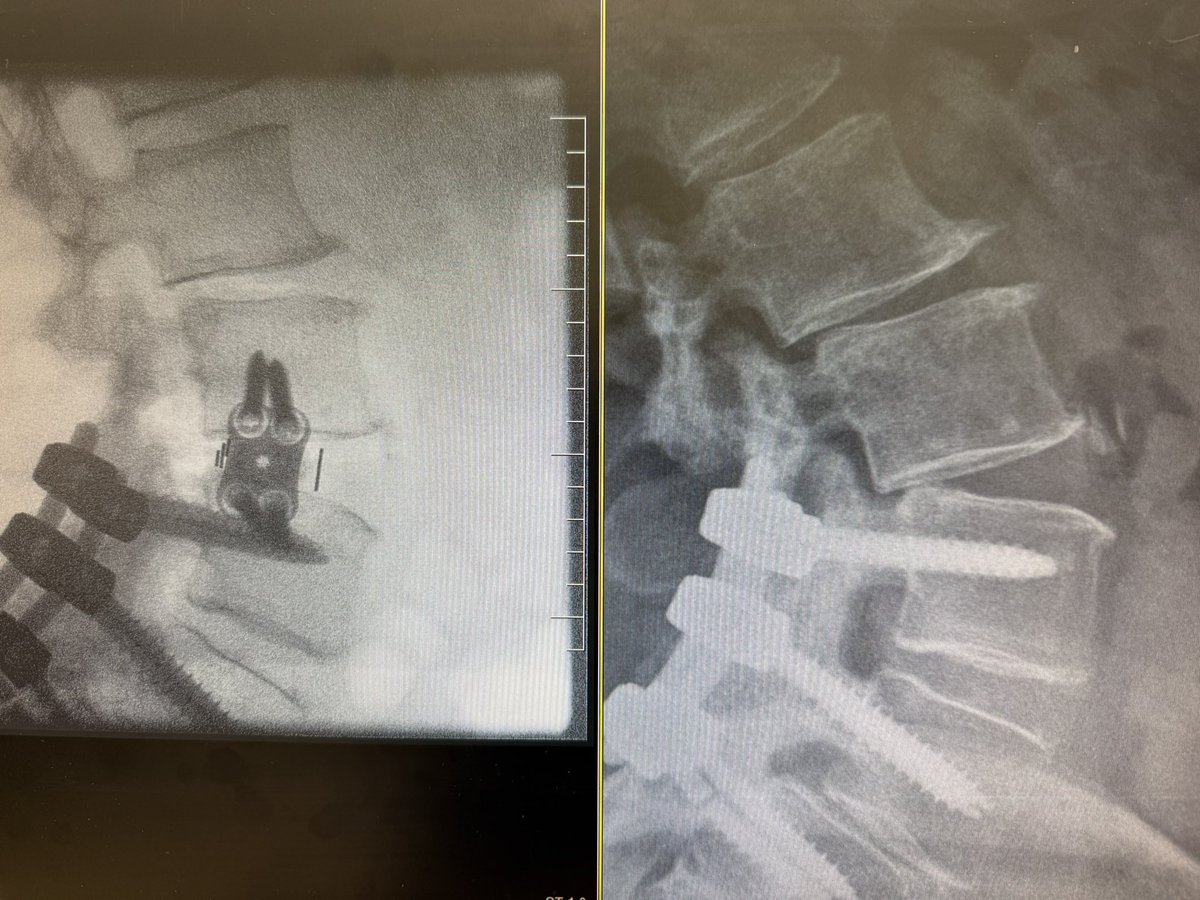 Tratamiento del Sd Adyacente mediante cirugía mínimamente invasiva XLIF. Conseguimos mejoría de los niveles adyacentes y una correcta descompresión indirecta. #cirugiaminimamenteinvasiva #columna #xlif #seaspine #acuñafombona #dr.dbosch #cst #traumagrup