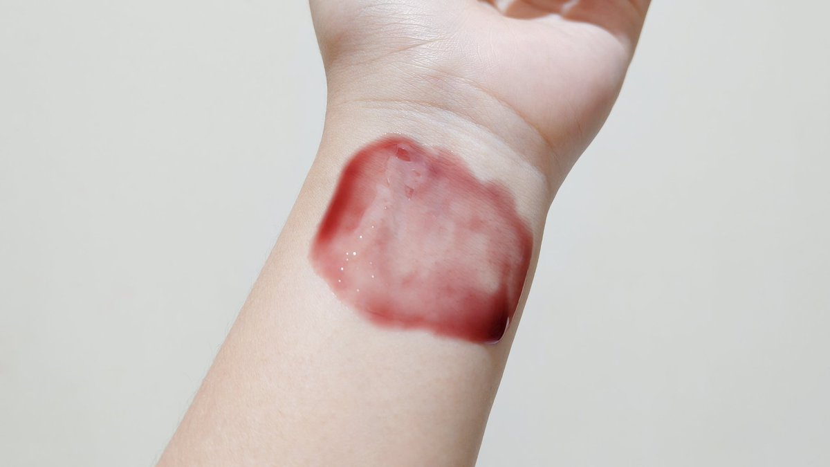 ตั้งแต่ได้เซรั่มแดงของ Skintific มาคือใช้บ่อยสุดๆ55555 ชอบมากกก ผลัดเซลล์ผิวดีมาก ละดูดิหน้าเนียนขึ้นกว่าเดิมเยอะเลยอะ เราใช้ครั้งละ 1 นาที ทาทิ้งไว้แล้วล้างออก แล้วก็จะใช้แค่ก่อนนอนเท่านั้น ส่วนตัวใช้แล้วผิวไม่บางลง ไม่ระคายผิว ผิวไม่เห่อ ไปต่อยาวๆเลยตัวนี้ #ใช้ดีบอกต่อ https://t.co/OiUhygi41A