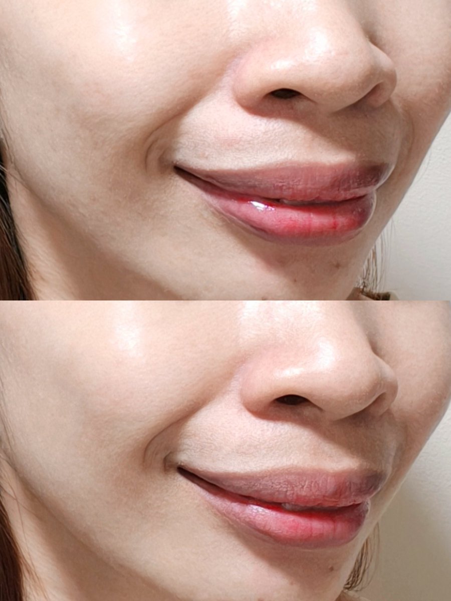 ตั้งแต่ได้เซรั่มแดงของ Skintific มาคือใช้บ่อยสุดๆ55555 ชอบมากกก ผลัดเซลล์ผิวดีมาก ละดูดิหน้าเนียนขึ้นกว่าเดิมเยอะเลยอะ เราใช้ครั้งละ 1 นาที ทาทิ้งไว้แล้วล้างออก แล้วก็จะใช้แค่ก่อนนอนเท่านั้น ส่วนตัวใช้แล้วผิวไม่บางลง ไม่ระคายผิว ผิวไม่เห่อ ไปต่อยาวๆเลยตัวนี้ #ใช้ดีบอกต่อ https://t.co/OiUhygi41A