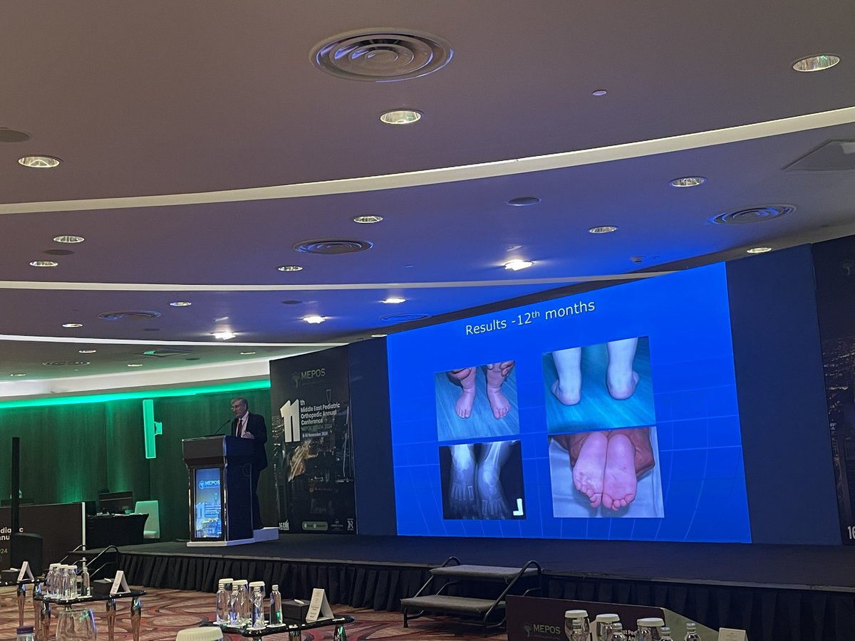 What a fantastic start to the first day of MEPOS! Professor Marcouende shared invaluable tips and tricks for managing clubfoot, drawing on his 25 years of experience. A key takeaway: in complex clubfeet, after casting, put them in 30° abduction, not 60°. #MEPOS2024 #MEPOS