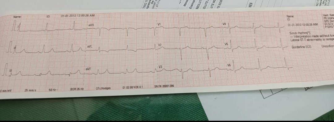 GoStudyFahad's tweet photo. @smithECGBlog @MagnusNossen Does this ecg shows aslanger pattern?@smithECGBlog https://t.co/EWZkhYTLMC