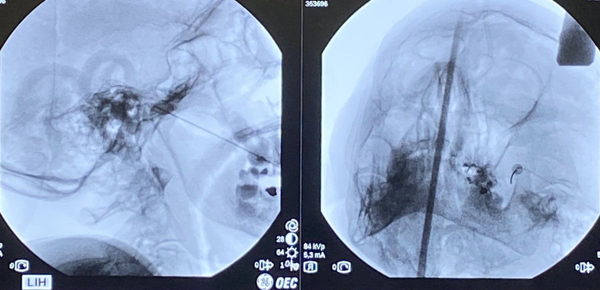 EXCELENTE CURSO 🤩
de RADIOFRECUENCIA AVANZADA 
de la mano de las DOCTORAS 🩺
NIETO 👩🏻  &amp; <a href="/maitebovaira/">Maite Bovaira Forner</a> 👩🏽 

¿Por qué debería realizarlo? 🤔

- PREPARA para el EXAMEN 📝
DE ACREDITACIÓN de la <a href="/Sedolor/">Sociedad Española del Dolor</a> 
- POCOS ALUMNOS (8-10) 👥
- Aprendizaje de TÉCNICAS COMPLEJAS con EXPERTOS 🤓
