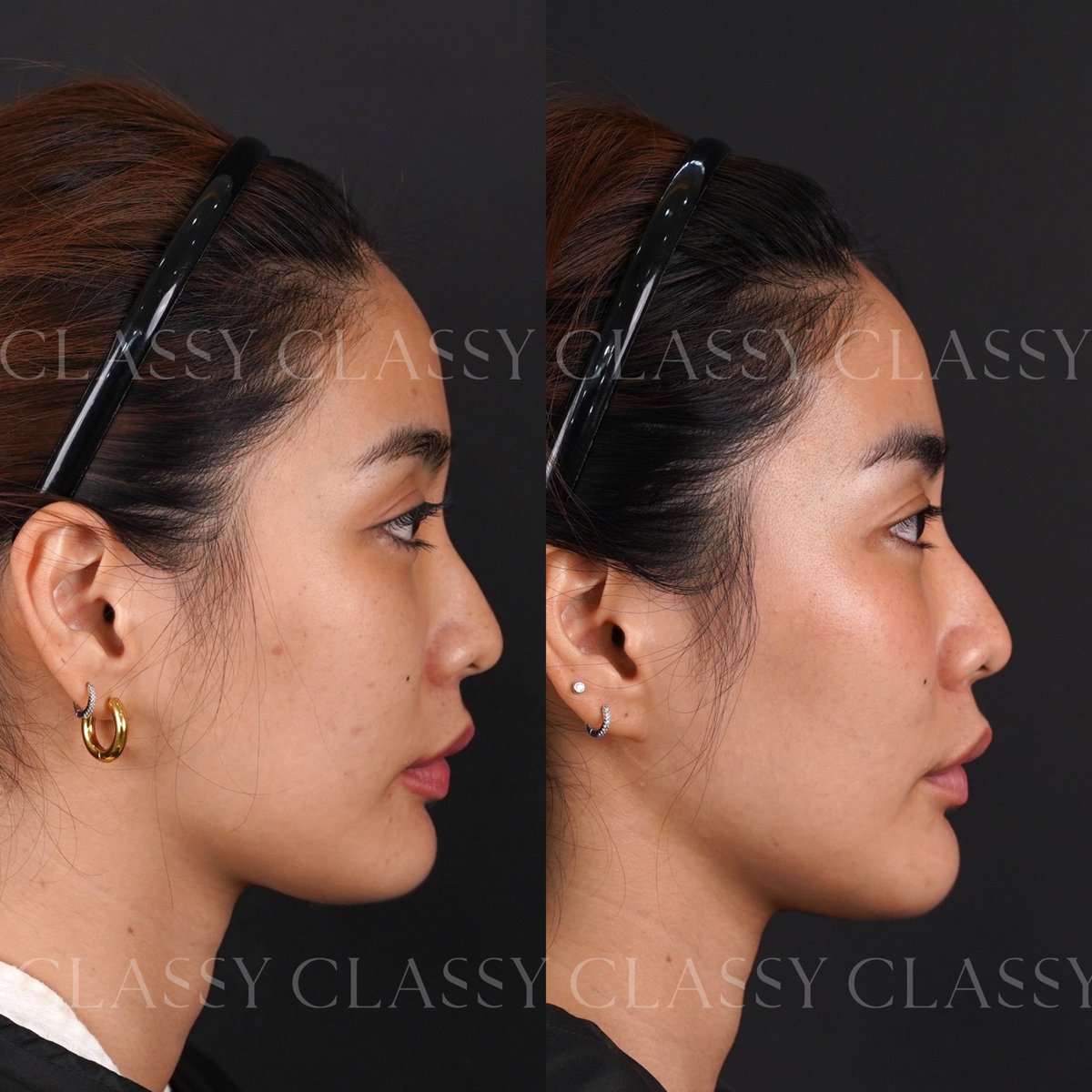 ClassyClinic's tweet photo. ปรับรูปหน้า ให้สวยทุกมุมมอง ดูมีมิติมากขึ้น ด้วยโปรแกรม Reset Plus ด้วยเทคนิค Z-line ที่ Classy Clinic✨

#classyclinic #ClassyFacialDesign 
#โปรแกร��ออกแบบรูปหน้า #ClassyRadiesse #resetplus https://t.co/gIga3lRL49